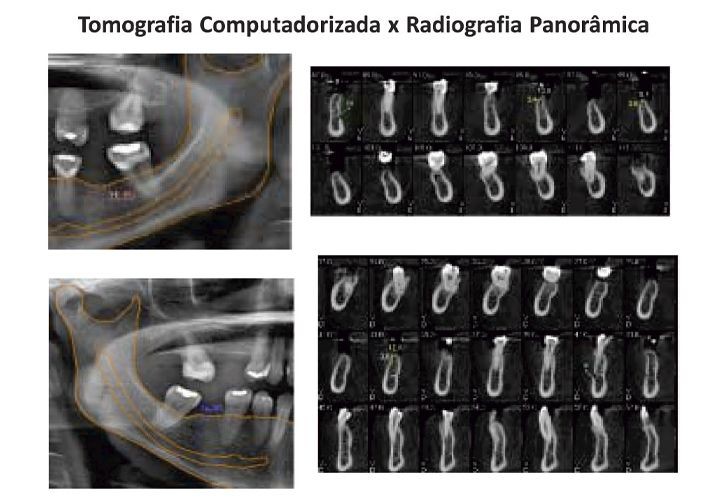 Avaliação Pré-Cirurgica em Implantodontia