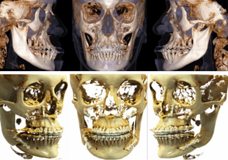 Cirurgia Ortognática: seus conceitos e indicações