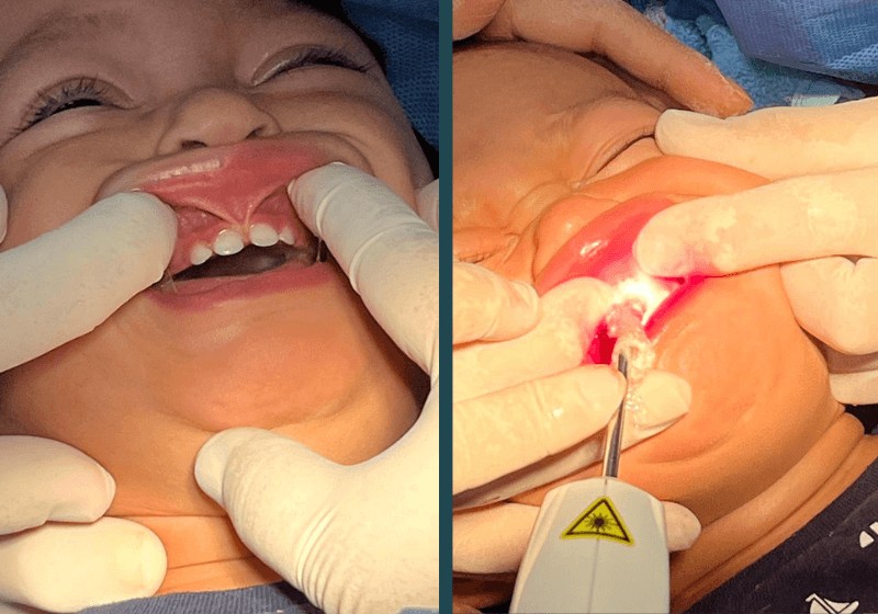 Frenectomia labial em bebê utilizando Laser de Diodo: relato de caso