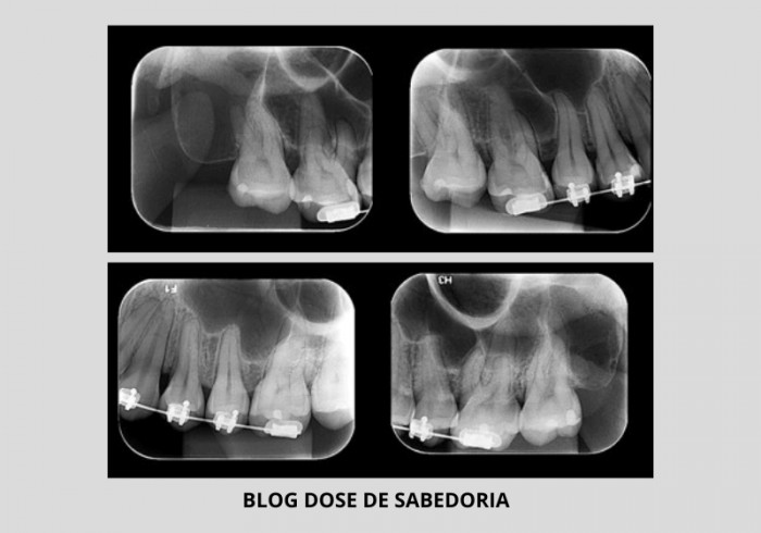 Extensão Alveolar detectadas em Radiografias Periapicais