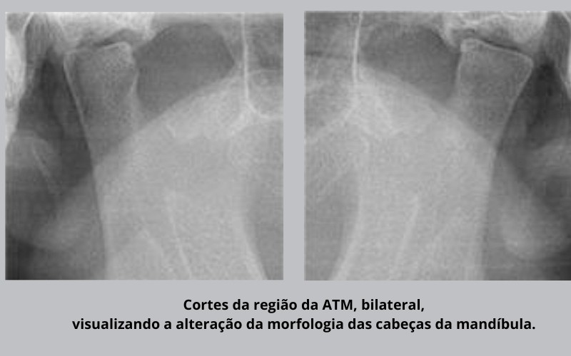 Mandíbula: Anatomia, estruturas e fraturas