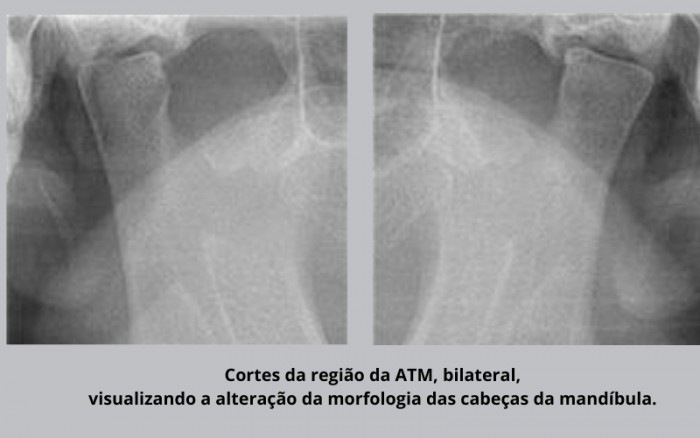 Avaliação Morfológica das Cabeças da Mandíbula nos exames de imagens