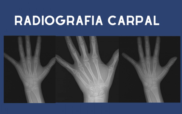 Radiografia Carpal