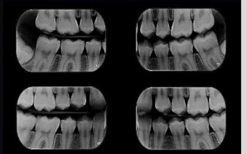 O uso da Radiografia Interproximal no planejamento clínico