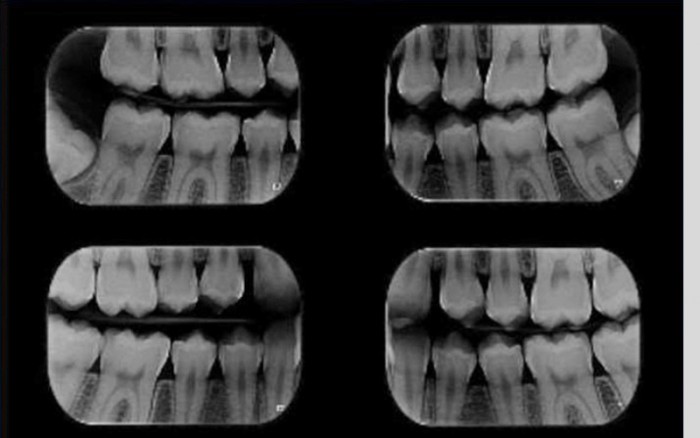 O uso da Radiografia Interproximal no planejamento clínico