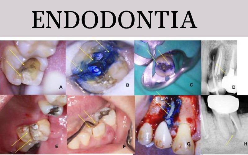 Endodontia: Diagnóstico e tratamento de trinca e fratura dental