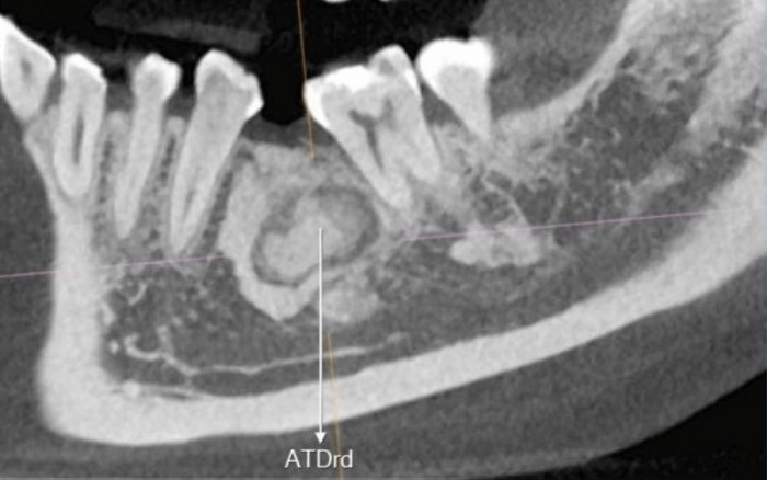 Lesão fibro-óssea Displasia Cemento Óssea Focal