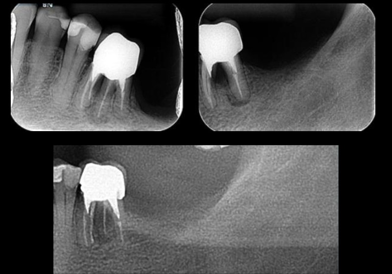 Curiosidade radiológica no dose de sabedoria: Radix Entomolaris