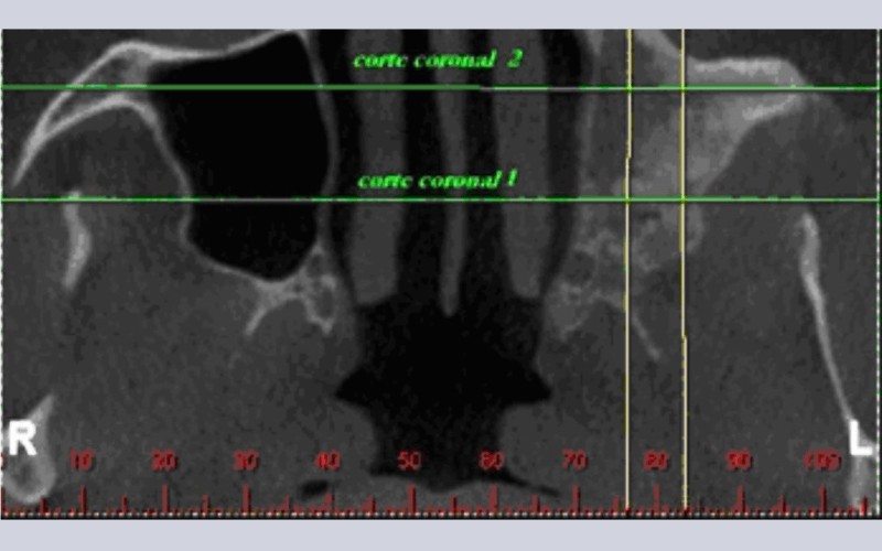 Científica - Rinossinusite Crônica