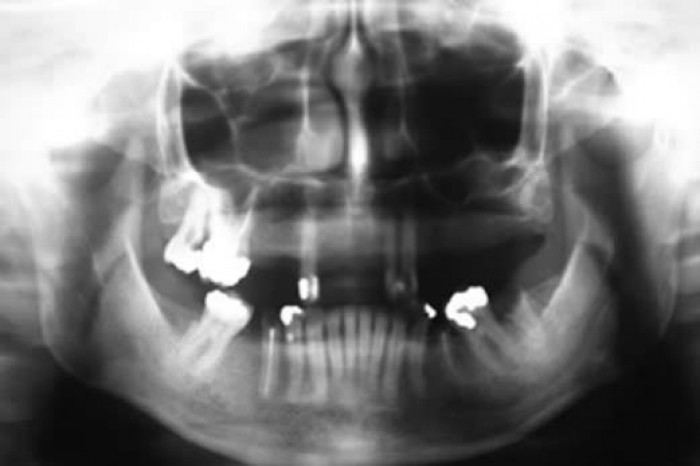 Osteotomia Sagital da Crista com Enxerto Interposicional - relato de caso clínico