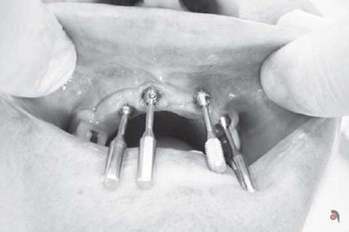 Prótese sobre Implante ou Compensação Protética