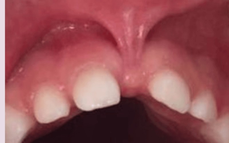 Cirurgia de Frenectomia