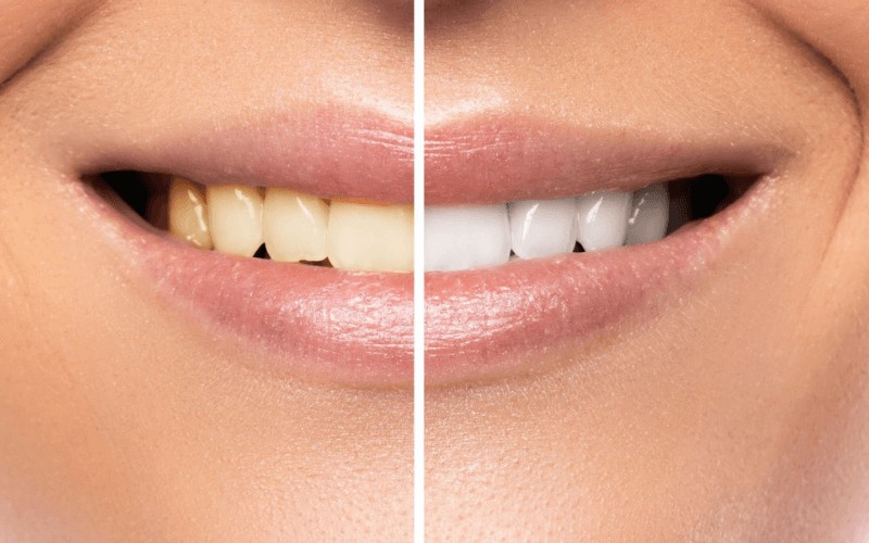 Curso de Dentistica Restauradora Estética