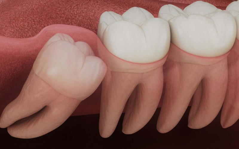 Remoção dos Terceiros Molares, popularmente conhecidos como Dentes Sisos