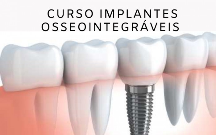 Em foco: Implantes Osseointegráveis e Prótese Sobre Implante