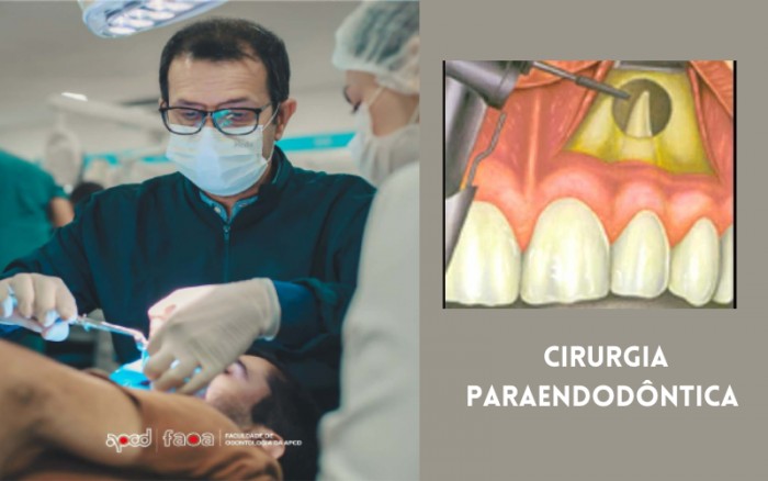 Cirurgias Paraendodônticas: fatores que asseguram bons resultados