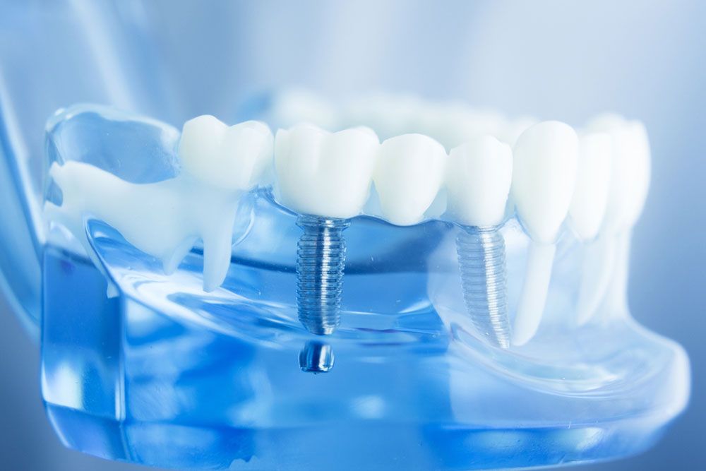 Relatório mostra que mercado mundial de implantes dentários deverá crescer 7,9% por ano até 2024