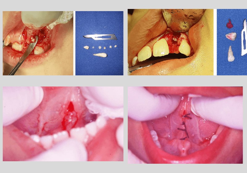 Cirurgia em Odontopediatria